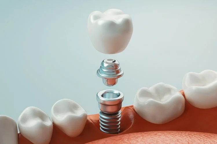 Tarpas tarp dantų – atvejis, kurį sprendžia dantų implantacija