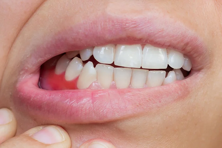 Kraujuojančios ir patinusios dantenos – ankstyvi lėtinio periodontito požymiai